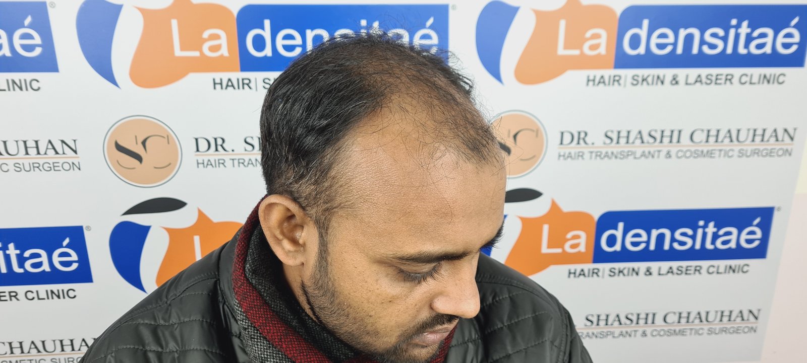 Abhay Pratap Yadav Before Hair Transplant